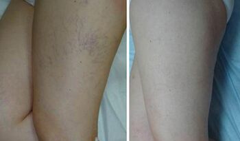 veins before and after application of the gel